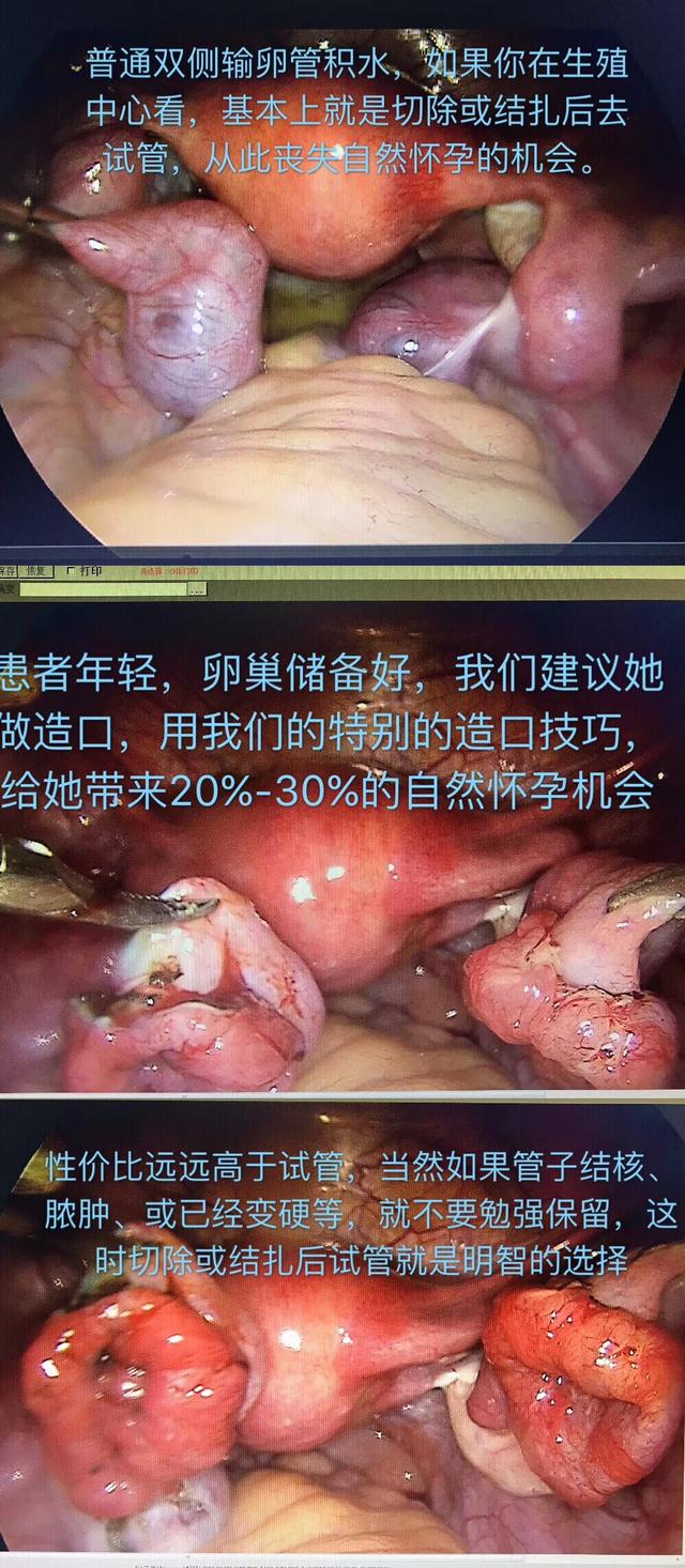 宫腔镜腹腔镜动画,宫腔镜和腹腔镜检查全过程