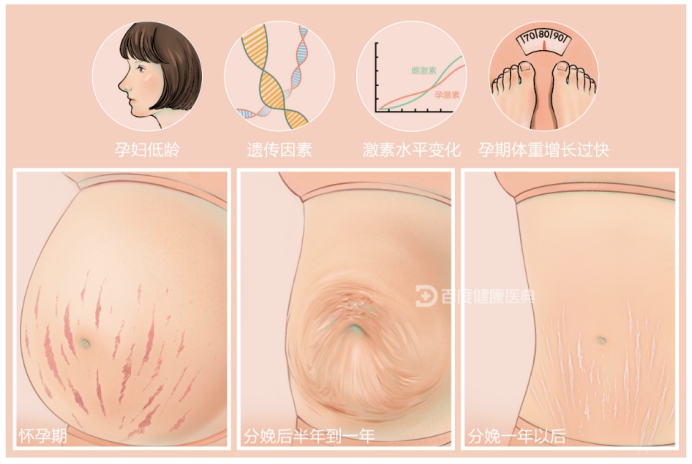 有妊娠纹不要怕一招教您轻松淡化,妊娠纹防不胜防你知道如何修复吗