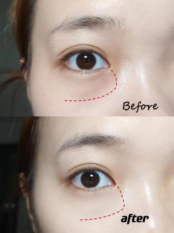 严重泪沟黑眼圈,淡化黑眼圈和泪沟原理