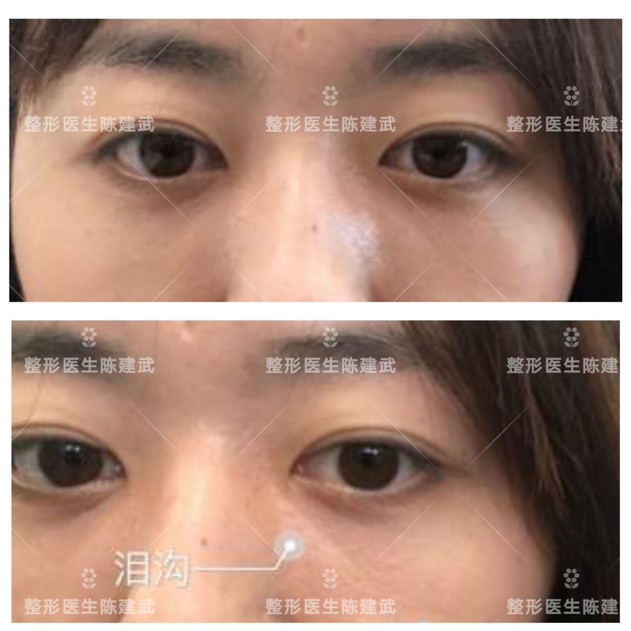 做眶隔释放眼袋后出现印第安纹,去眼袋出现印第安纹