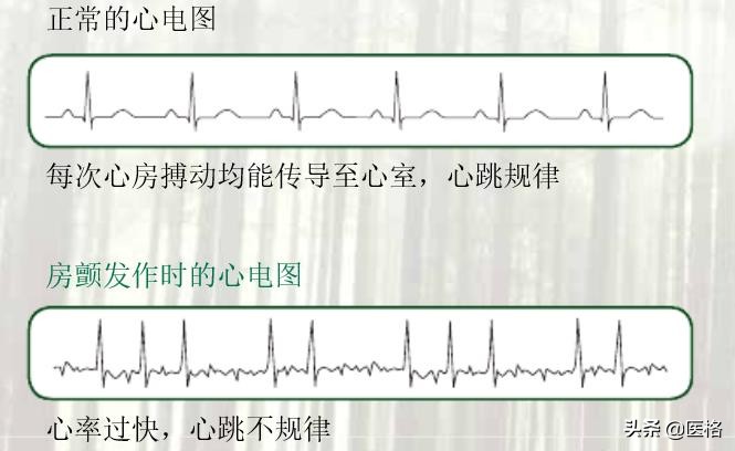 房颤脑梗的治疗方法大全,房颤怎么治才能彻底好