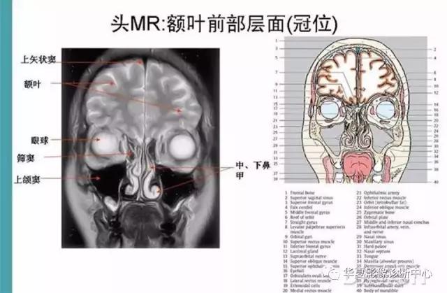 mra头颅解剖学详细讲解视频,常见的头颅mri图像