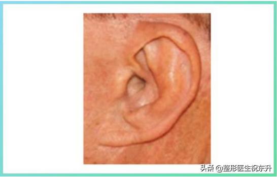 面部除皱手术全过程,面部除皱术的七大类详解