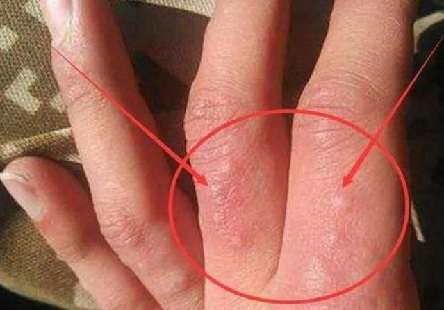 天气一热手上长水泡脱皮,为了避免手上起水泡该怎么预防