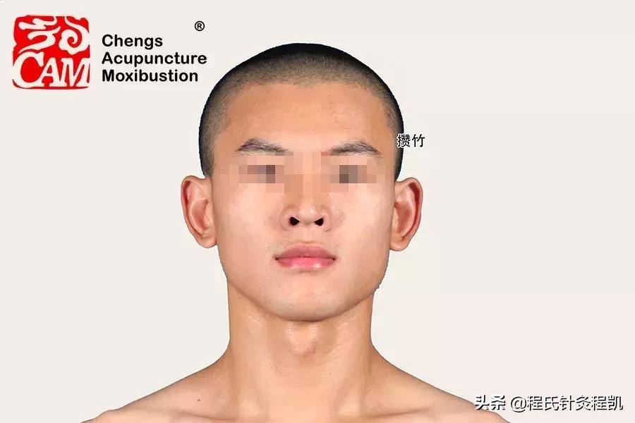 急性腰扭伤按哪个穴位图解,马立强手法治疗急性腰扭伤