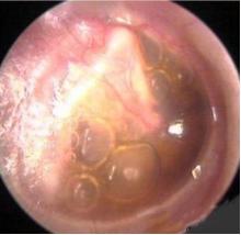 小孩说耳朵疼是中耳炎吗,儿童中耳炎引起的耳痛怎么解决