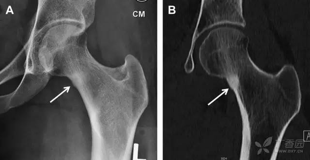 常见的八种骨折,容易漏诊的肩关节骨折
