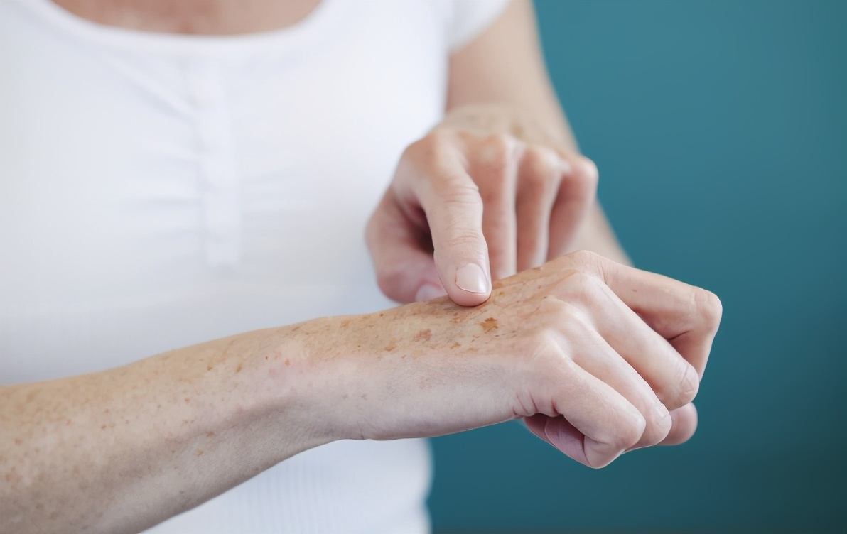 身上长了“老年斑”，有办法淡化或彻底去除吗？医生：有4种方法