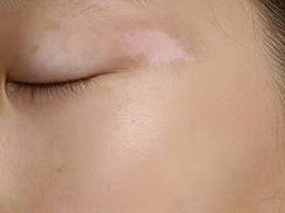 皮肤上长白癜风应该怎么治？稳定期的白癜风治疗用什么方法好？