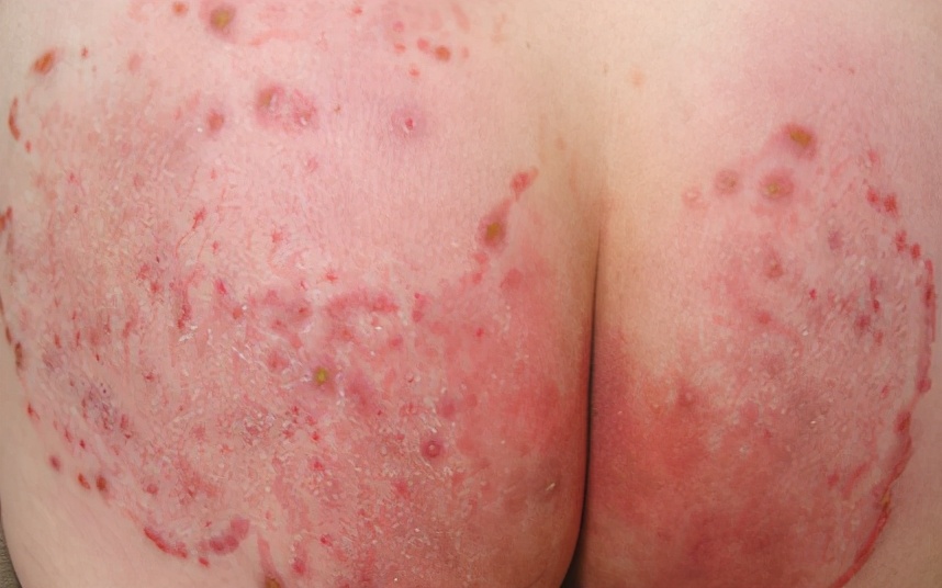 得了股癣要注意些什么,股癣吃什么抗真菌的药