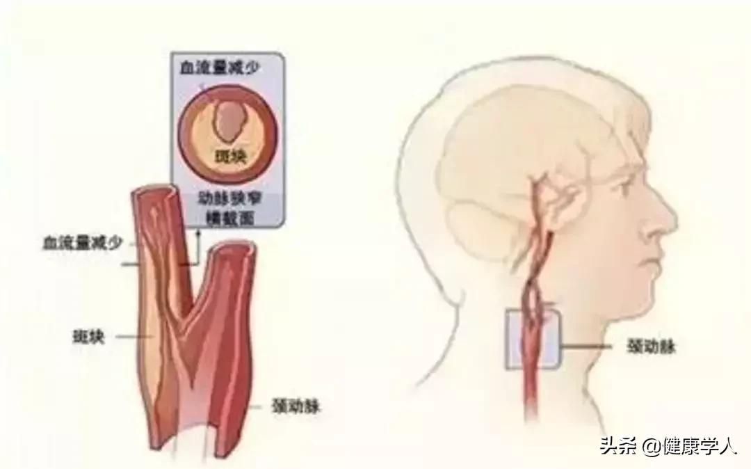 脑梗死最可怕的一关,脑梗死濒临死亡的症状