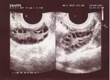 哪些症状提示多囊卵巢综合征？我们该如何诊断？
