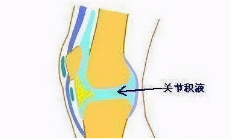 膝关节半月板损伤有积液怎么治疗,膝关节滑膜炎积液怎么治疗最好