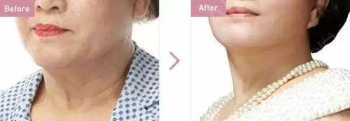 人衰老面部变化,面部衰老改善最好的方法