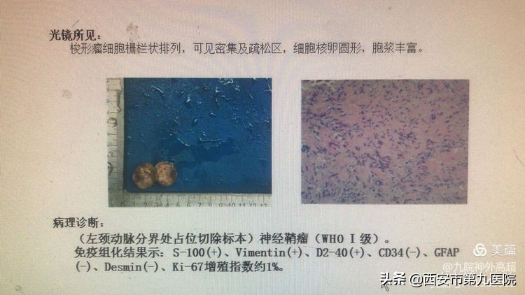 脖子上长一个神经瘤需要手术吗,颈动脉上有个凸起疑是动脉瘤
