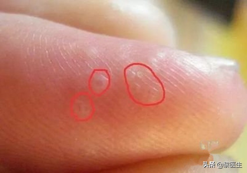 得了汗疱疹后感冒了,得了汗疱疹能健身吗