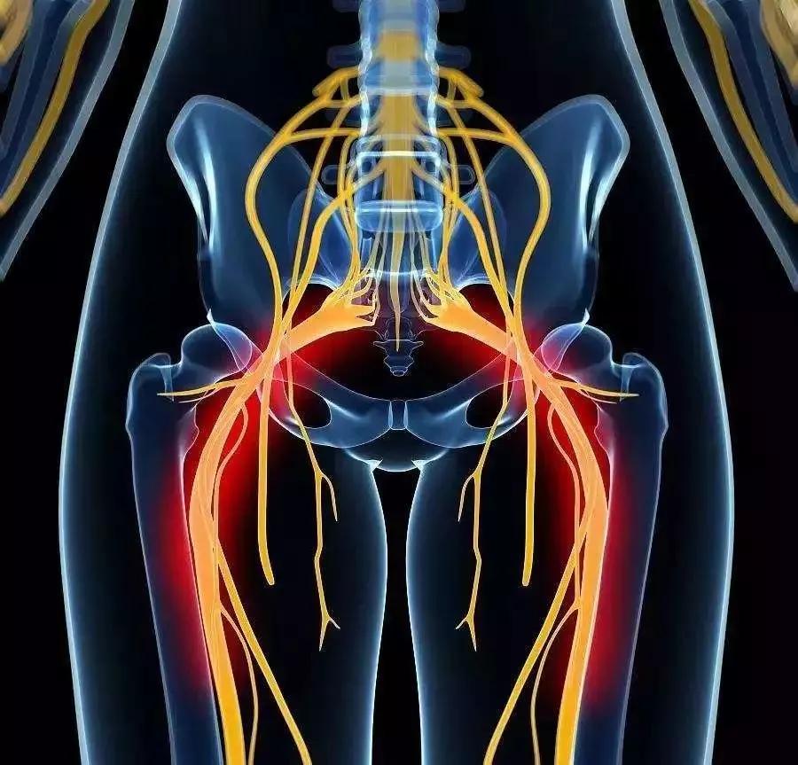 3个动作让你远离腰间盘突出,民间高人治疗坐骨神经痛土方法