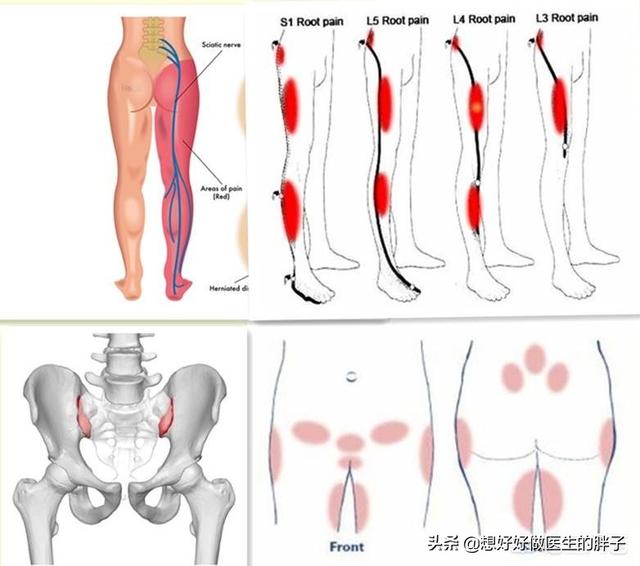 髋关节疼痛会引起腿痛吗,髋关节疼痛两腿不一样长如何康复