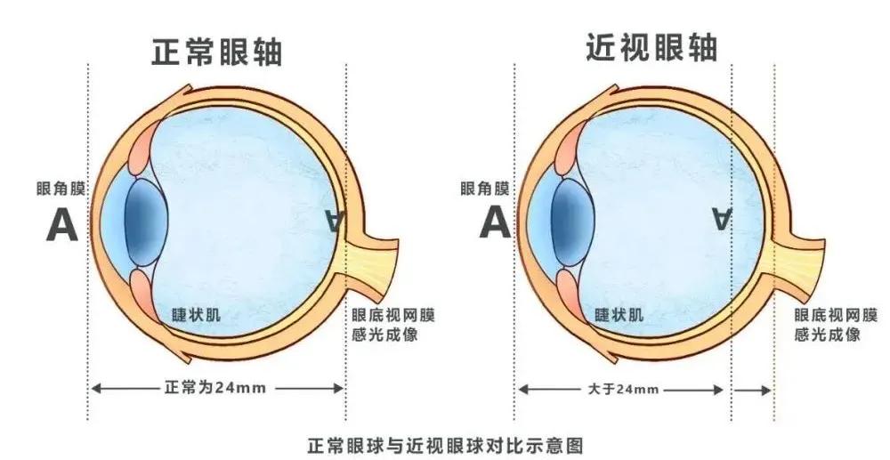 青少年近视一年增长多少度,青少年发育期眼睛近视加快
