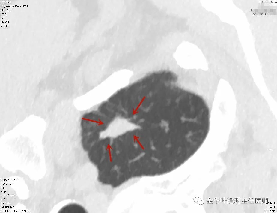 叶建明谈实性结节,叶建明肺实性良性结节会变癌症吗