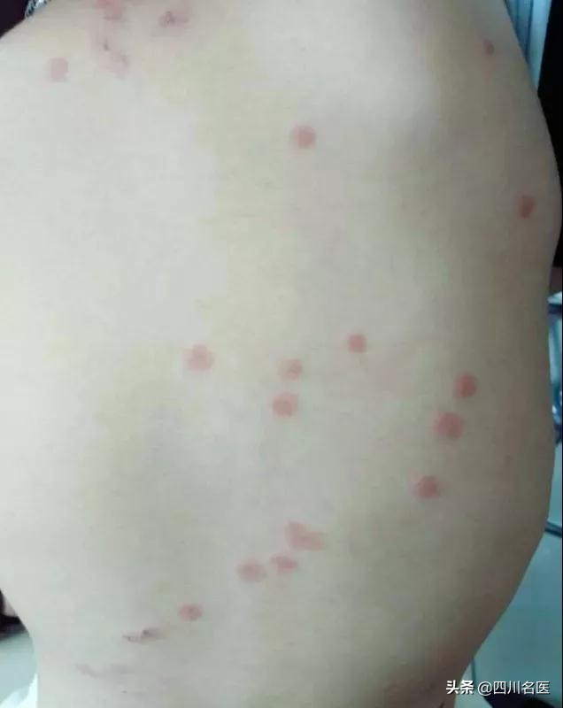女儿全身红疹是什么,3岁多女孩全身红疹呕吐