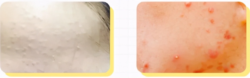 长闭口了怎么办!告诉你答案哦