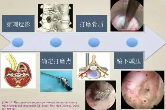 成功开展“钥匙孔”技术治疗颈椎病