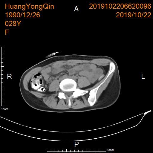 介入栓塞治疗巧克力囊肿,介入超声治巧克力囊肿需要多久