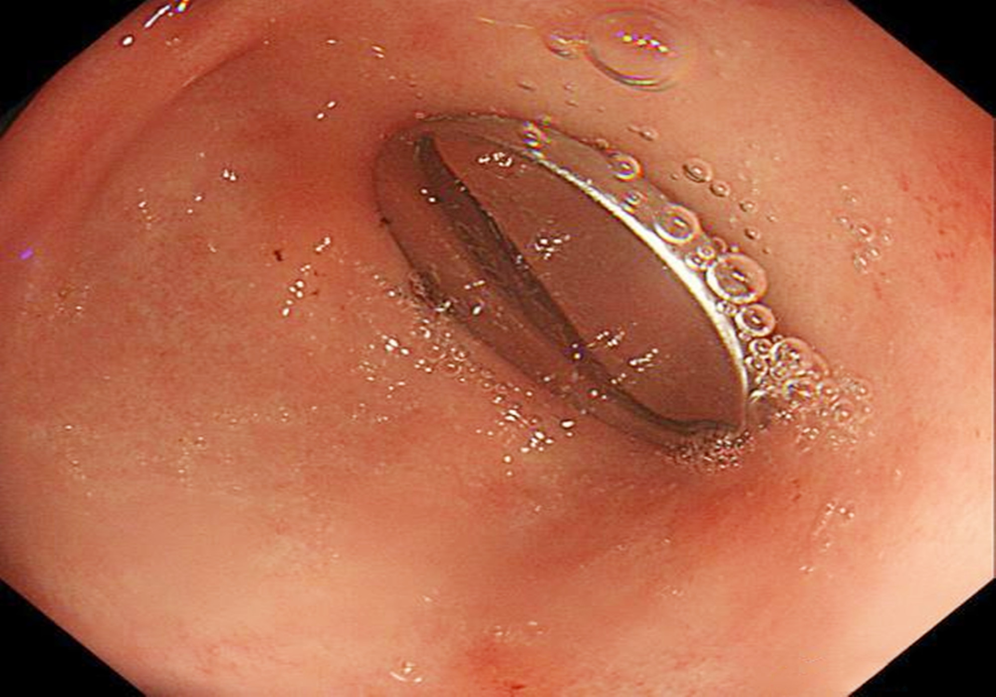 宝宝误吞纽扣,孩子误吞异物妈妈急救