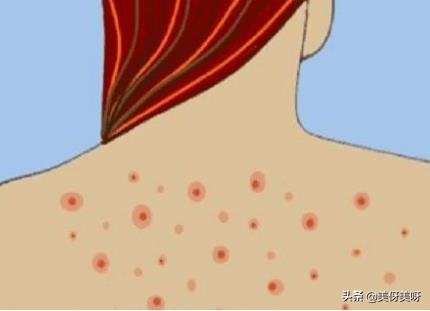 背后长痘痘怎么办最快最有效,背后长痘痘的原因和解决办法