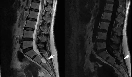 腰腿疼是哪些经络阻塞,腰囊肿疼是怎么回事