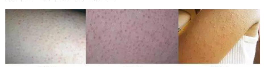 秋冬保湿去鸡皮死皮,瑕疵皮冬季护肤