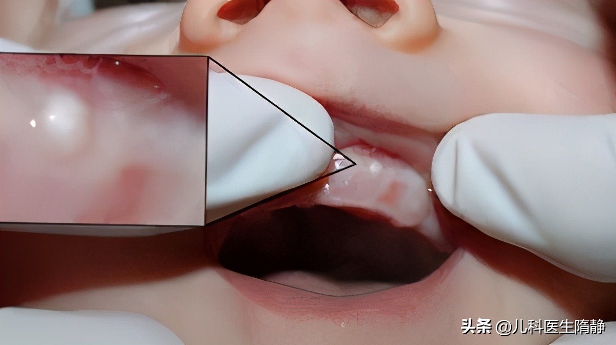 新生儿一些面部正常现象,新生儿出现这五种症状