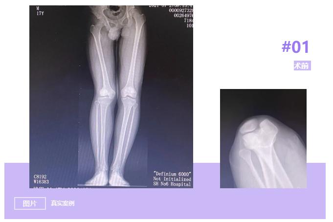 长短腿骨盆倾斜,二郎腿骨盆纠正