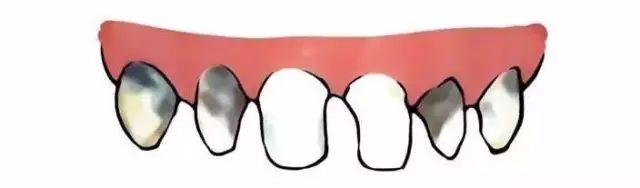 一岁孩子门牙奶瓶龋怎么办,两岁宝宝牙齿有奶瓶龋