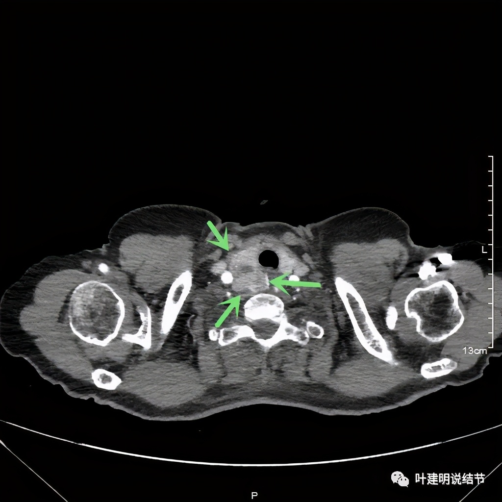 胸部高分辨ct检查注意事项,胸部ct扫描有没有危害