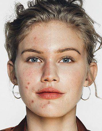 痘痘痘印的正确处理方法,痘痘留下的痘印应如何正确处理