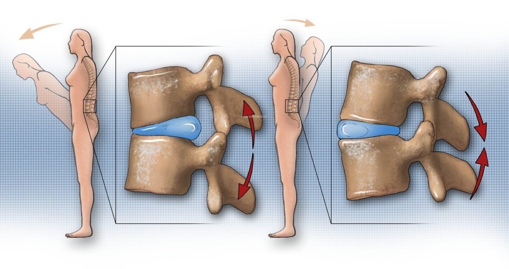 腰椎间盘突出要少运动？不宜跑步和健步走？医生：正确运动康复快