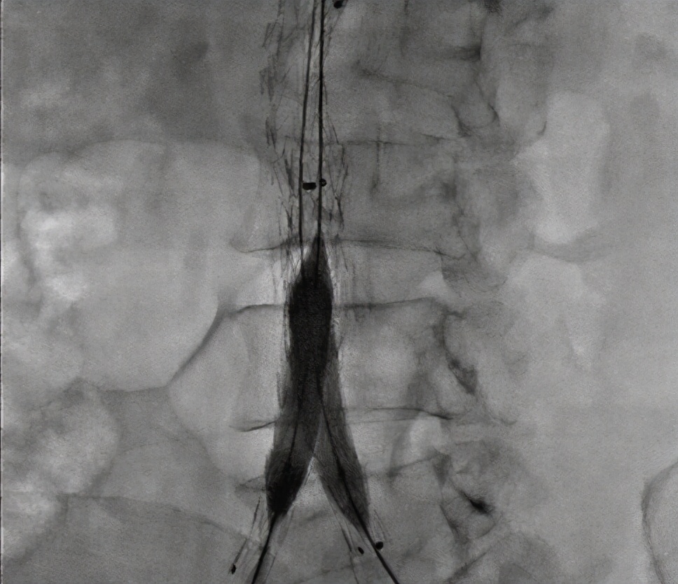 腹主动脉瘤最好的中成药治疗偏方,手术治疗腹主动脉瘤的方法有哪些