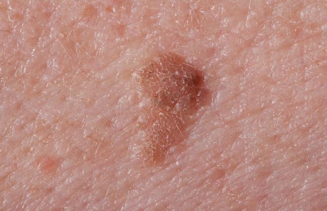 妇科医生给的忠告女人少生气,女性查出hpv需要注意什么