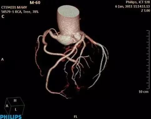 怀疑有冠心病必须做冠脉ct造影吗,确诊冠心病有必要做冠脉CTA吗