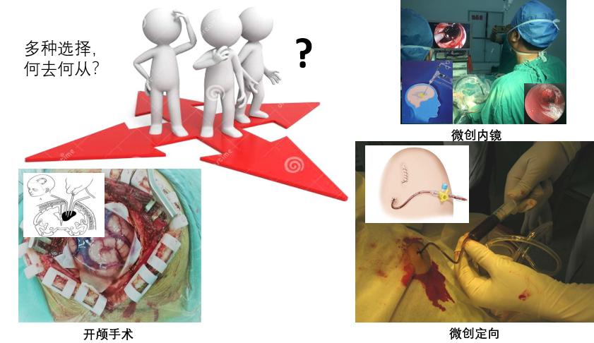 脑出血是开颅好还是引流好,脑出血是手术好还是保守治疗好