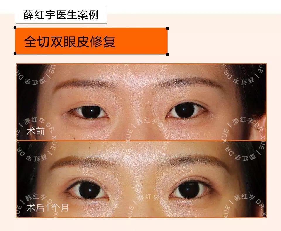 双眼皮整形修复,潘贰双眼皮修复
