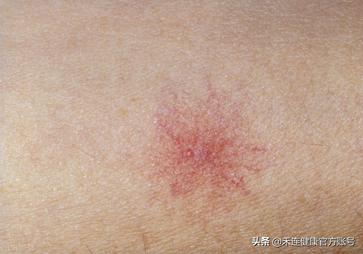 身上出现小红点是肝出现问题了吗,身上有小红点跟肝有关系吗