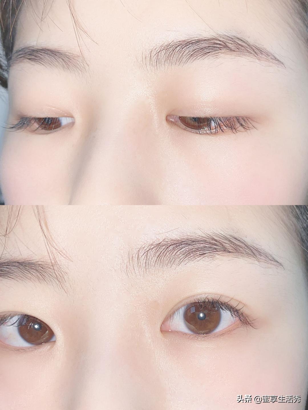 内双眼皮怎么变外双按摩最有效,内双眼皮手术变外双效果