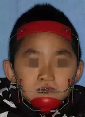 什么叫地包天怎么治疗,什么叫地包天能矫正吗