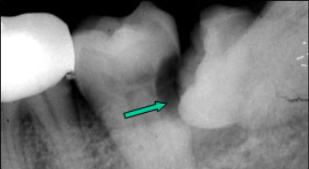 智齿蛀牙痛有什么有效方法止痛,智齿旁边牙松动蛀牙如何处理