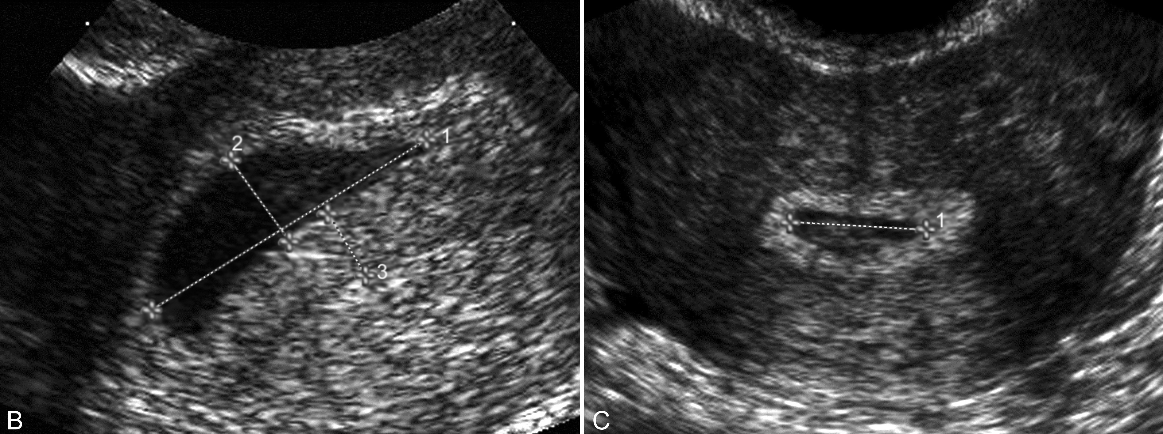 无痛输卵管超声造影全过程图解,输卵管间质部妊娠超声图像