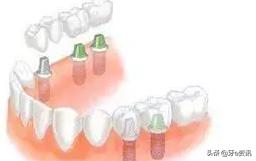 烤瓷牙价格表图种植牙,种植牙与烤瓷牙利与弊