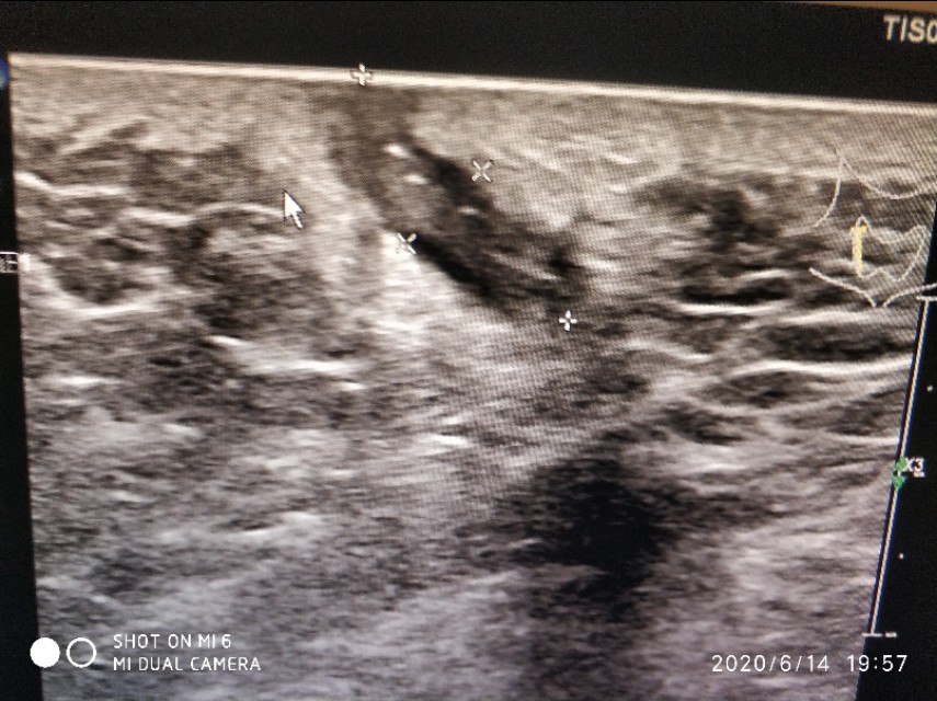 骶尾部囊肿手术多久可以弯腰,骶尾部囊肿和藏毛窦哪个严重